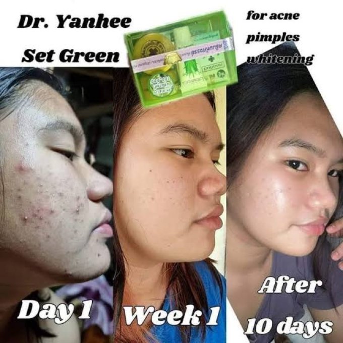 KIT VISAGE DR YANHEE ANTI ACNE